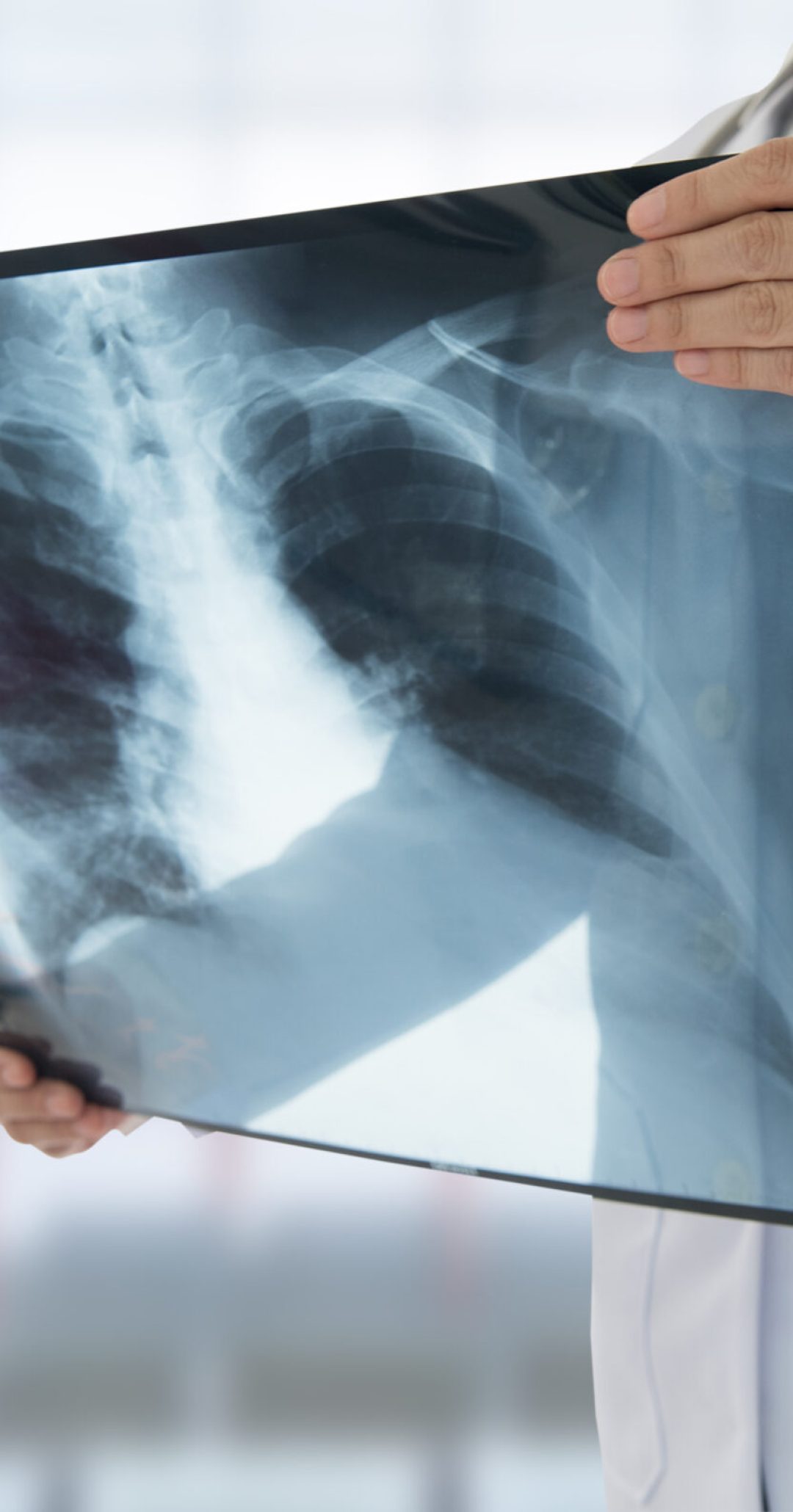 Doctor,Examining,Chest,X-ray,Film,Of,Patient,At,Hospital.